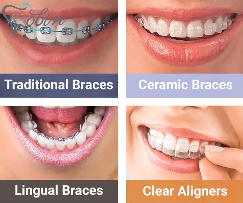 ۴ نوع ارتودنسی دندان